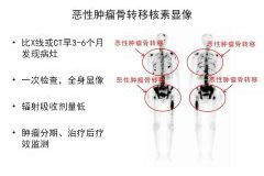 上饶市人民(mín)医院核医學(xué)科(kē)骨检查与治疗